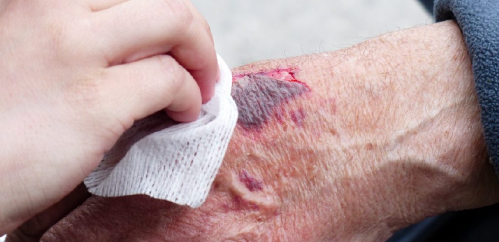 How to Get Dried Blood From Under Skin