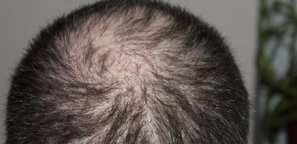 How to Grow Hair Back After Hair Loss