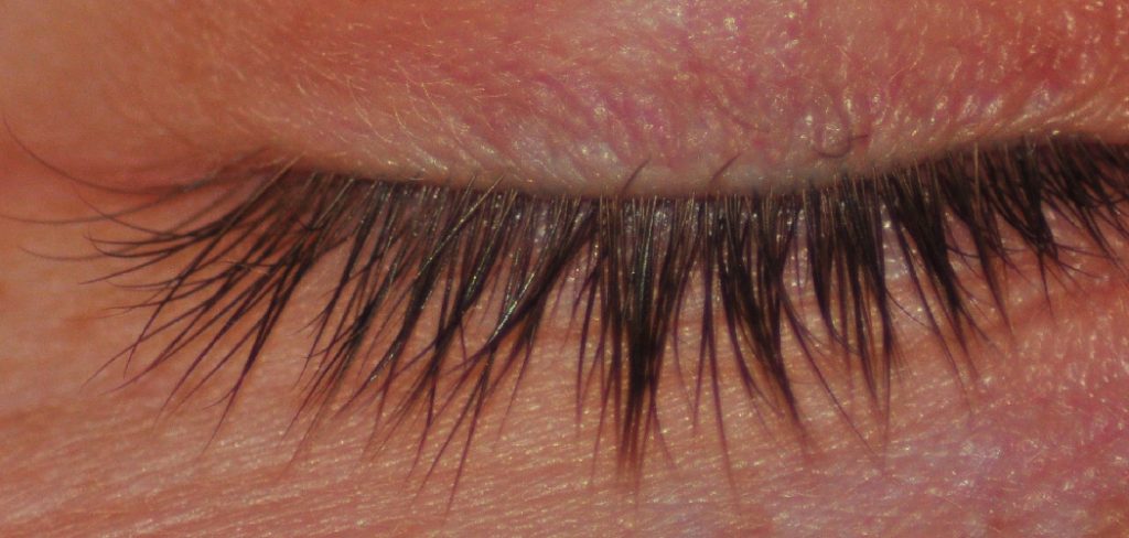 How to Get Rid of Veins on Eyelids