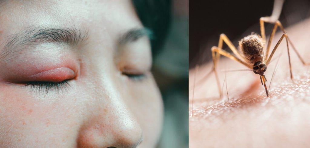 How to Treat Mosquito Bite on Eyelid