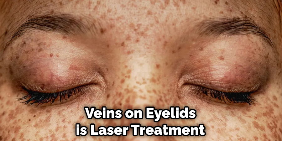 Veins on Eyelids is Laser Treatment