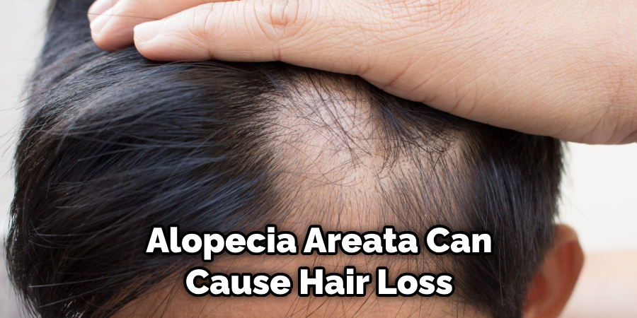 Alopecia Areata Can Cause Hair Loss