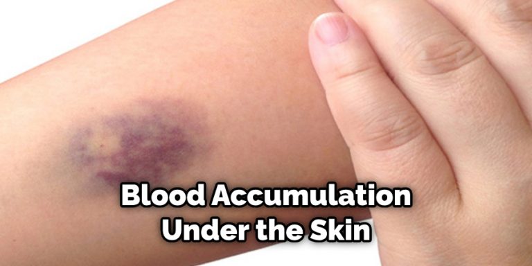 How To Get Dried Blood From Under Skin