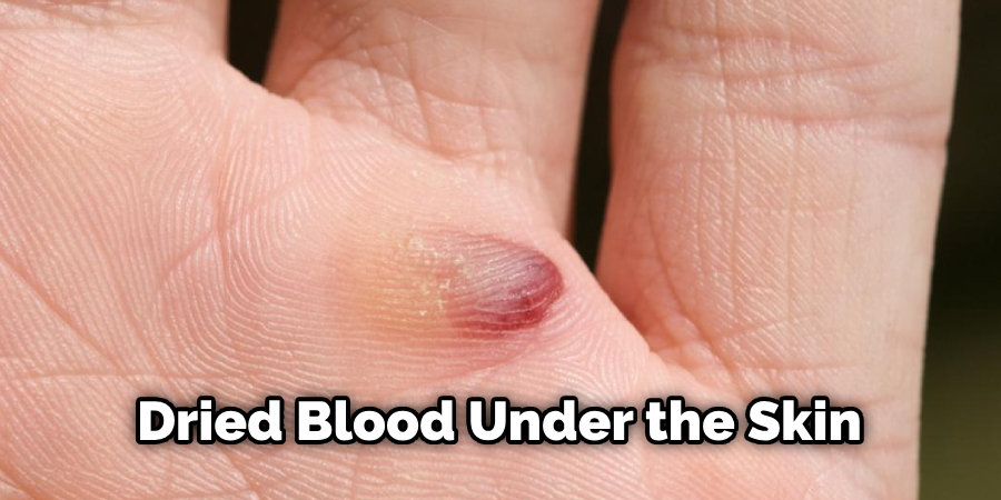 Dried Blood Under the Skin