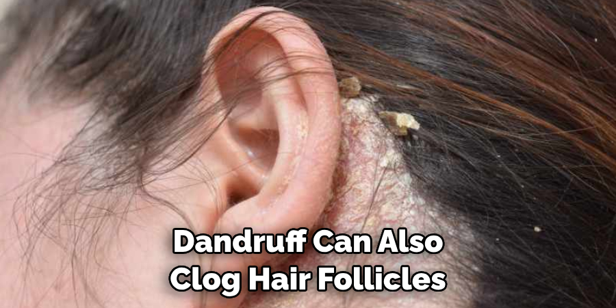 Dandruff Can Also Clog Hair Follicles