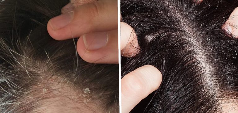 How to Fix Dry Scalp in Winter