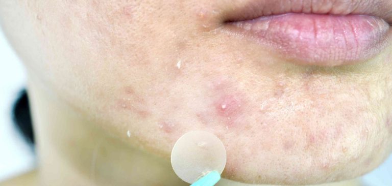 How to Use a Pimple Patch
