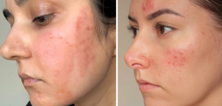 How to Cover Chemical Burn on Face