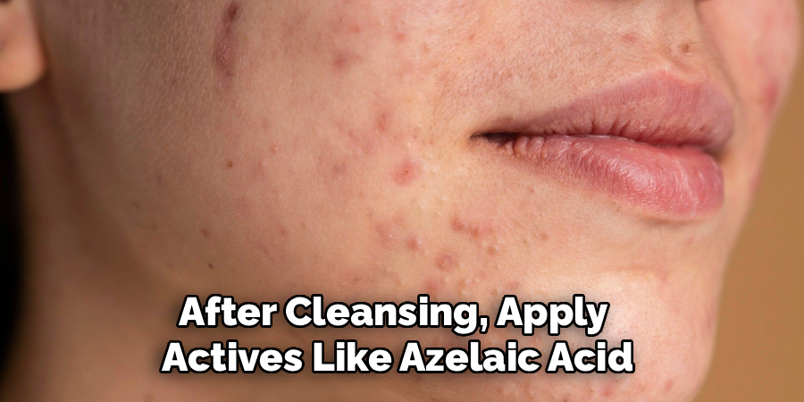 After Cleansing, Apply
Actives Like Azelaic Acid