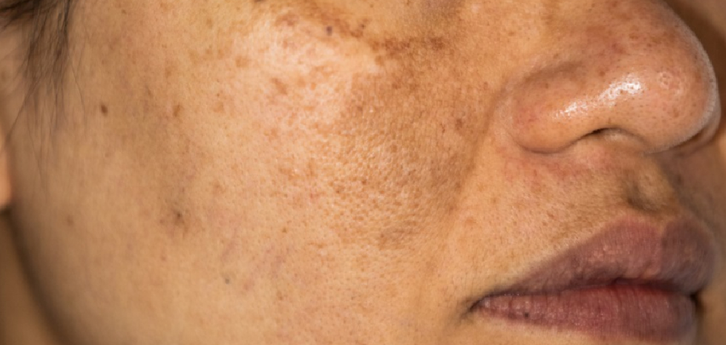 How to Conceal Melasma with Makeup