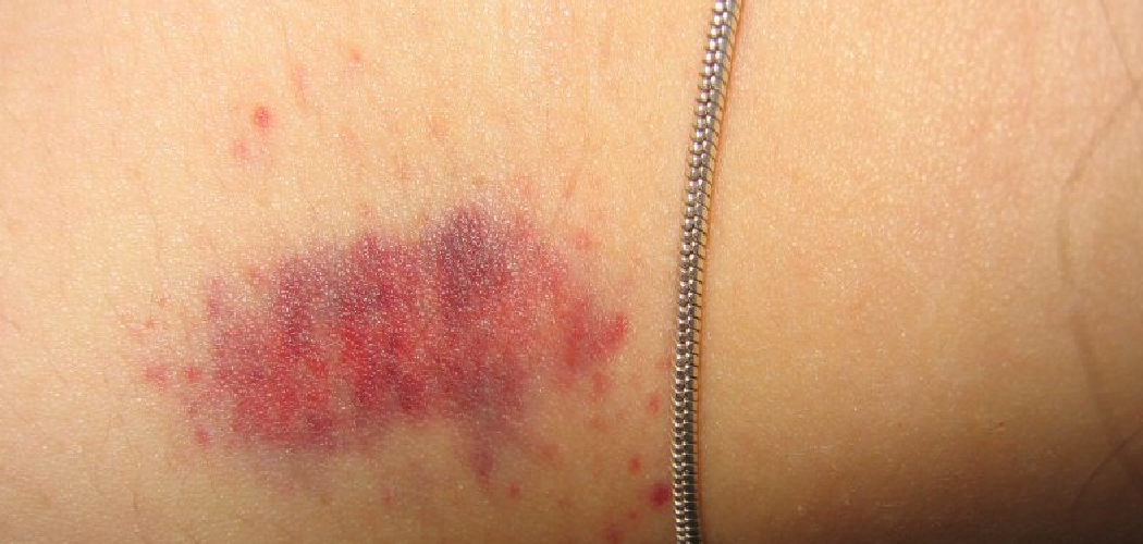 How to Cover Up Hickeys with Makeup