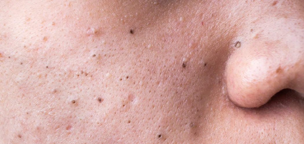 How to Remove Blackheads with Vaseline