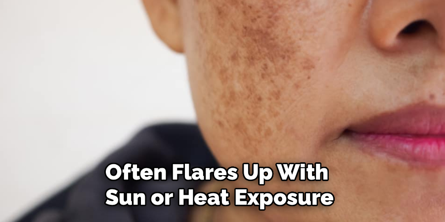 Often Flares Up With
Sun or Heat Exposure