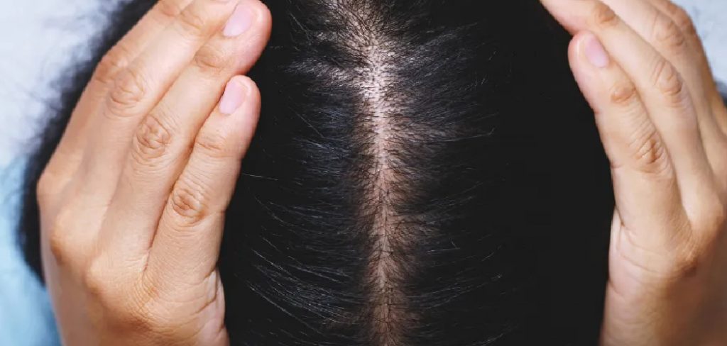 How to Get Rid of Dandruff After Dying Hair