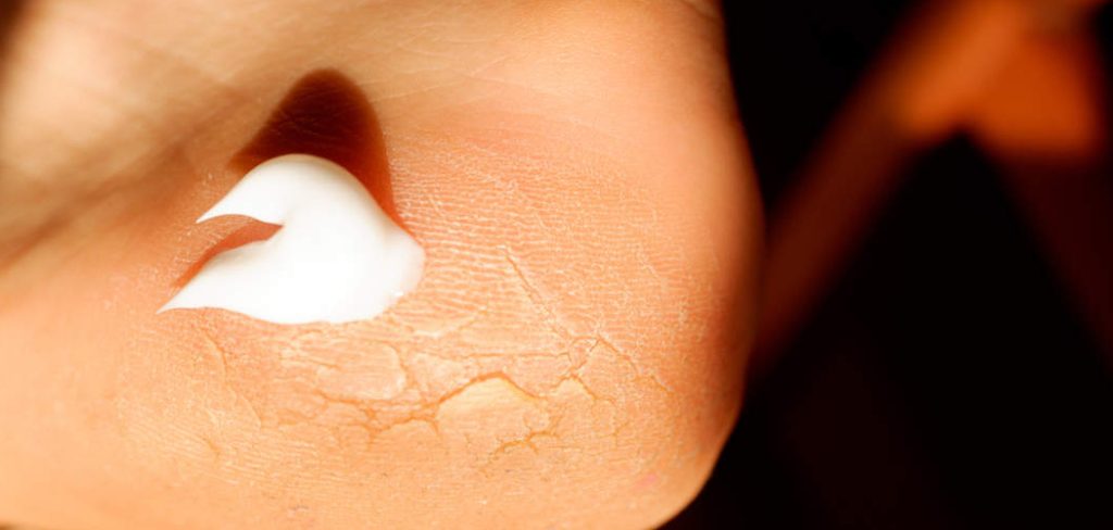 How to Use Urea 40 Cream on Feet