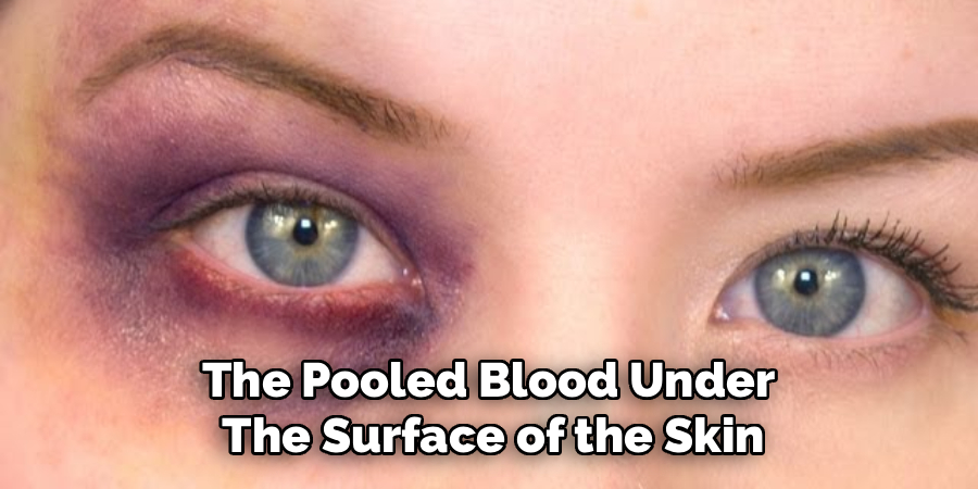 The Pooled Blood Under
The Surface of the Skin