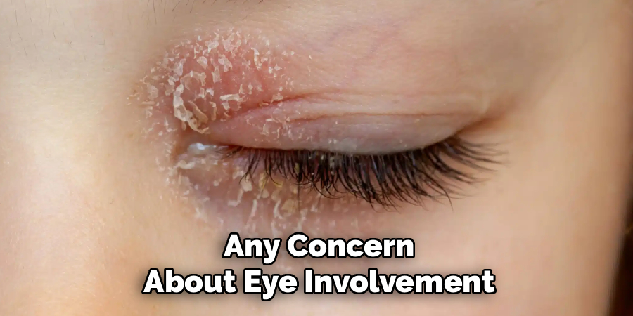 Any Concern About Eye Involvement