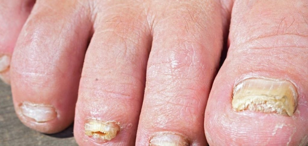 How to Remove Nail Polish Stains From Toenails