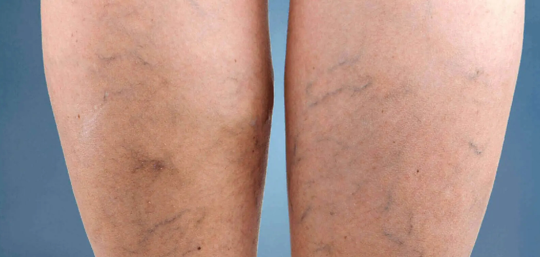 How to Cover Varicose Veins With Makeup