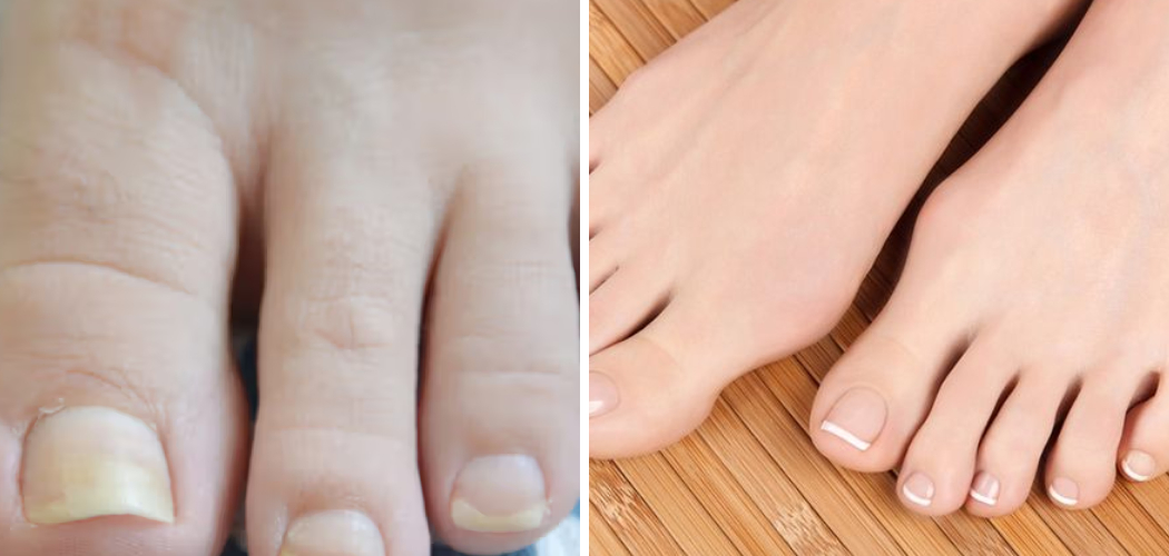 How to Whiten Yellow Toenails Naturally